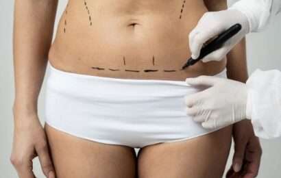 Diástasis abdominal: una condición frecuente post embarazo que tiene solución quirúrgica  Diástasis abdominal: una condición frecuente post embarazo que tiene solución quirúrgica