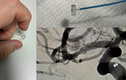 Inédita intervención endovascular en el Hospital “San Martín” de La Plata